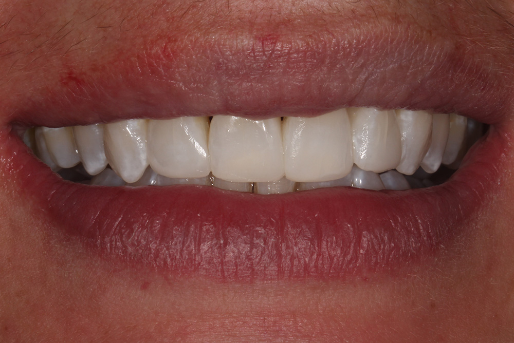  treatment by Paul Reaney adult braces armagh