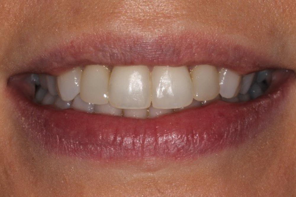 adult braces, tooth whitening and composite bonding