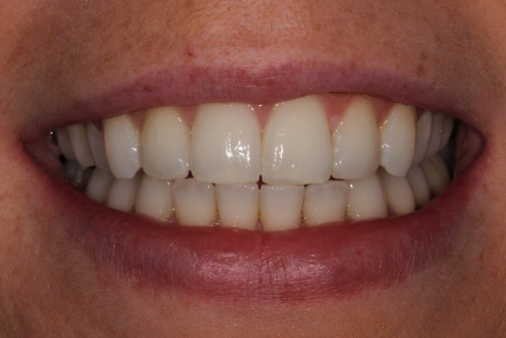 adult braces, tooth whitening and composite bonding