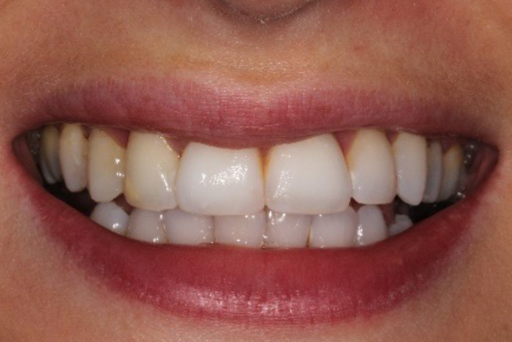 adult braces, tooth whitening and composite bonding