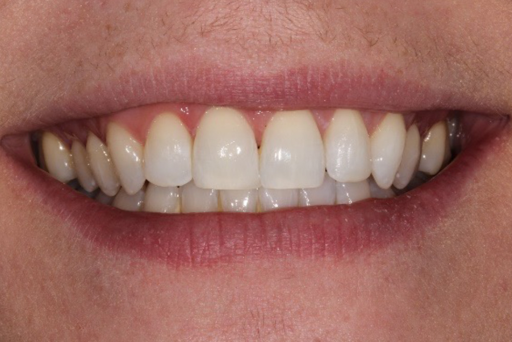 adult braces, tooth whitening and composite bonding