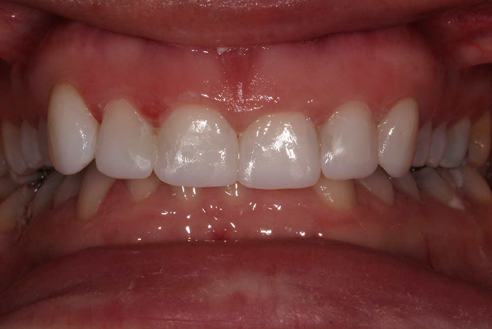  treatment by Paul Reaney adult braces armagh