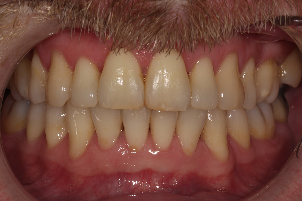 adult braces, tooth whitening and composite bonding