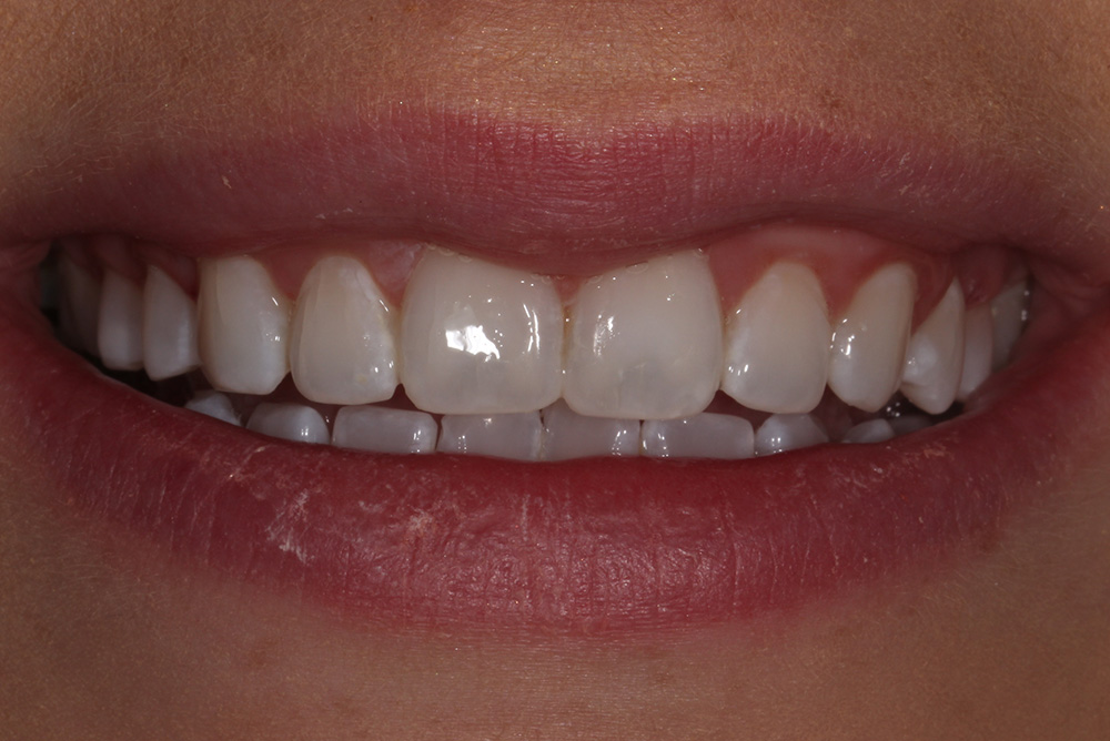 adult braces, tooth whitening and composite bonding