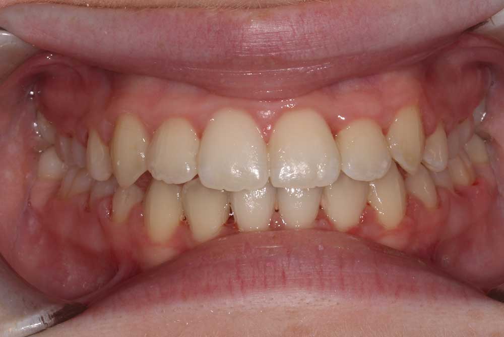 dental crowns armagh