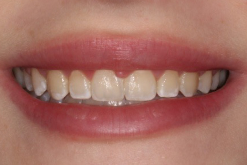 dental crowns armagh