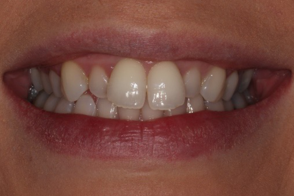 adult braces, tooth whitening and composite bonding