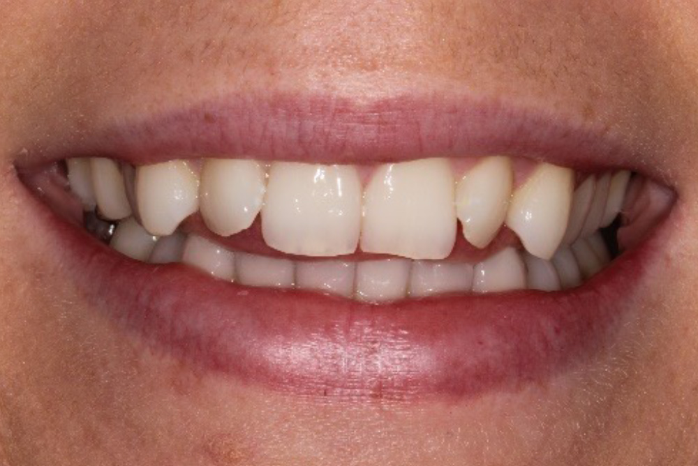 adult braces, tooth whitening and composite bonding