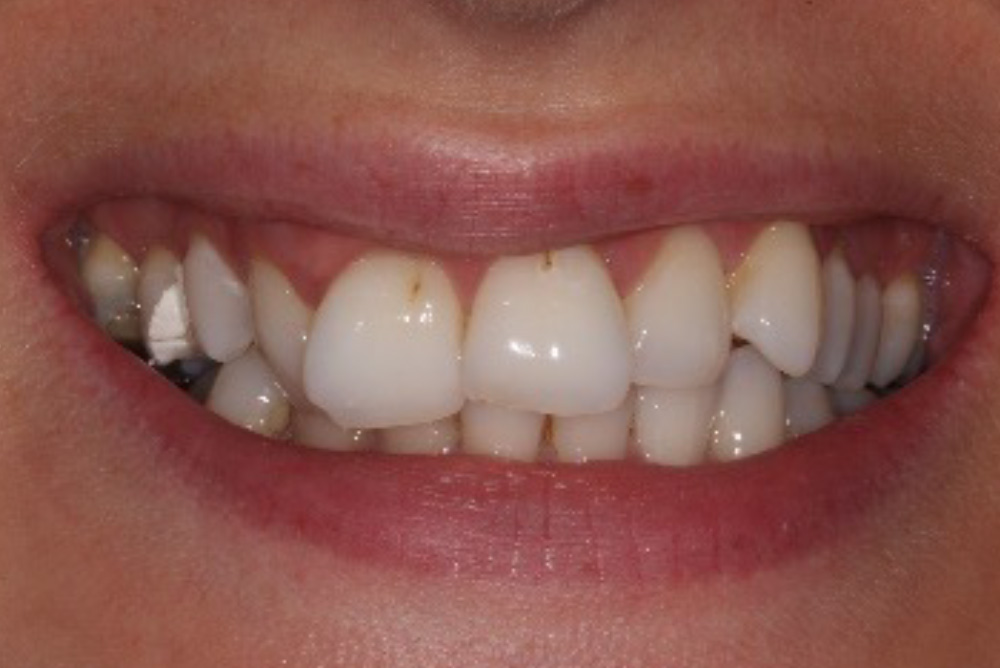 adult braces, tooth whitening and composite bonding