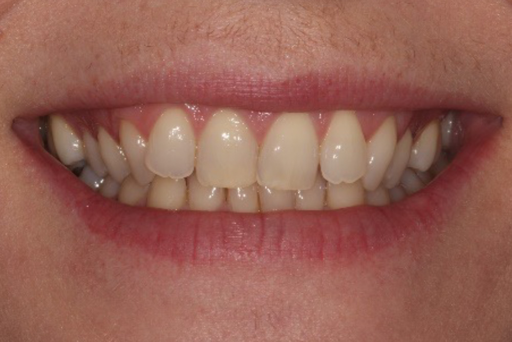 adult braces, tooth whitening and composite bonding