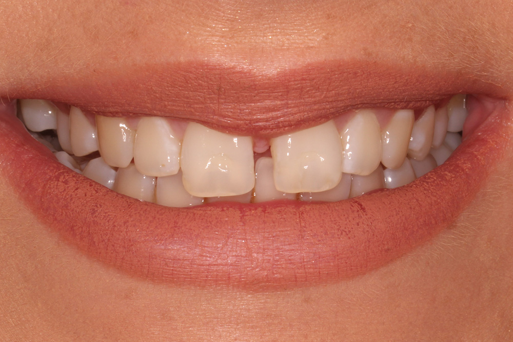 adult braces, tooth whitening and composite bonding