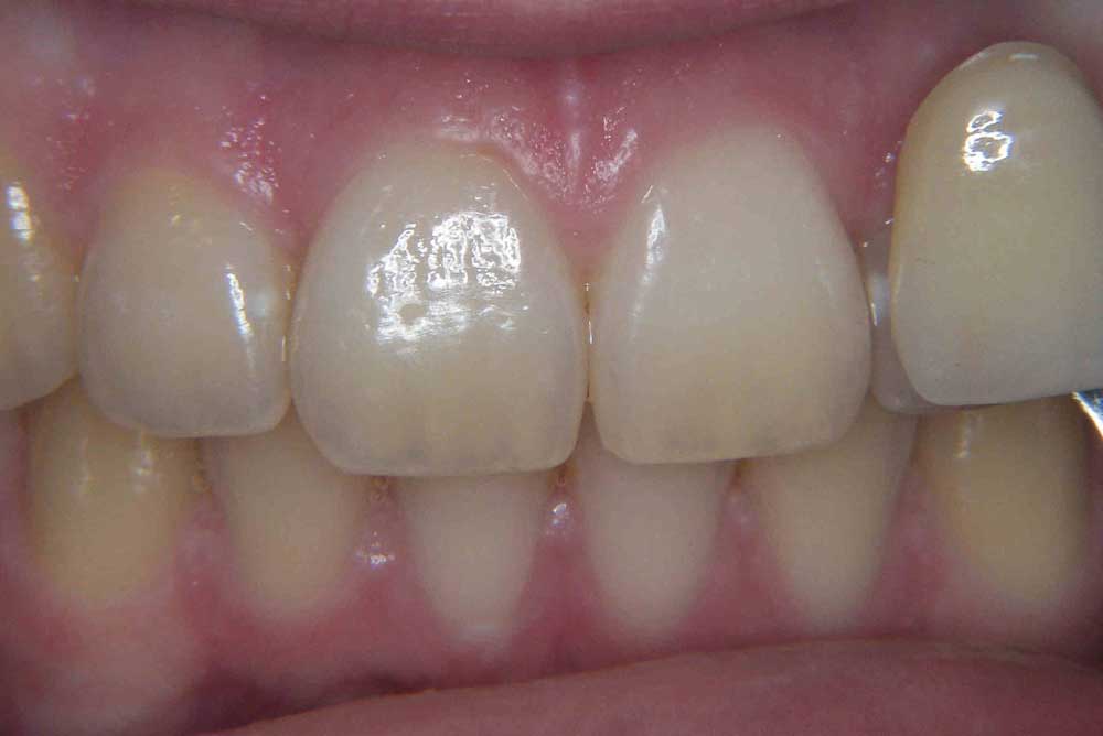 tooth whitening northern ireland