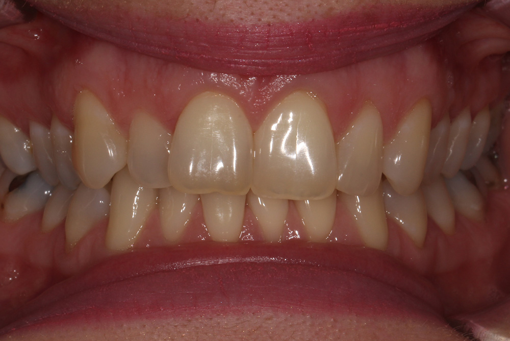 adult braces, tooth whitening and composite bonding