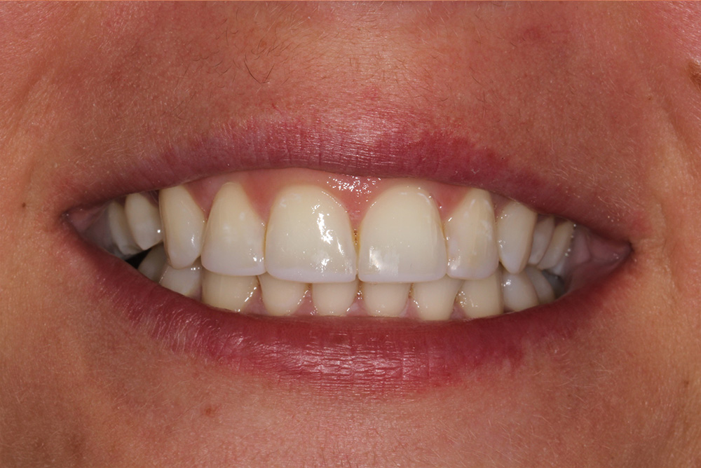 adult braces, tooth whitening and composite bonding