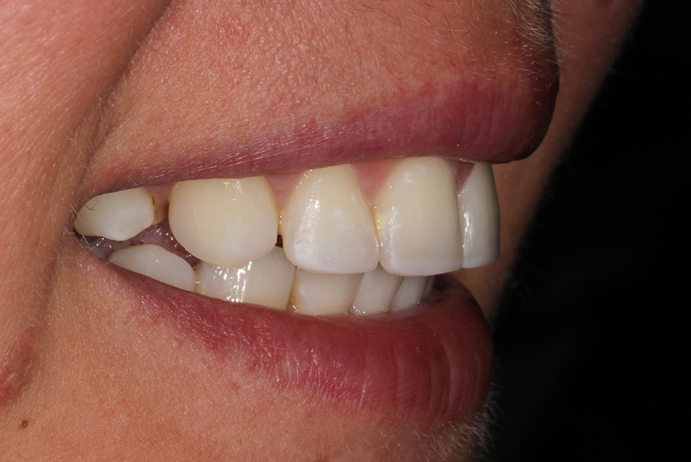 adult braces, tooth whitening and composite bonding