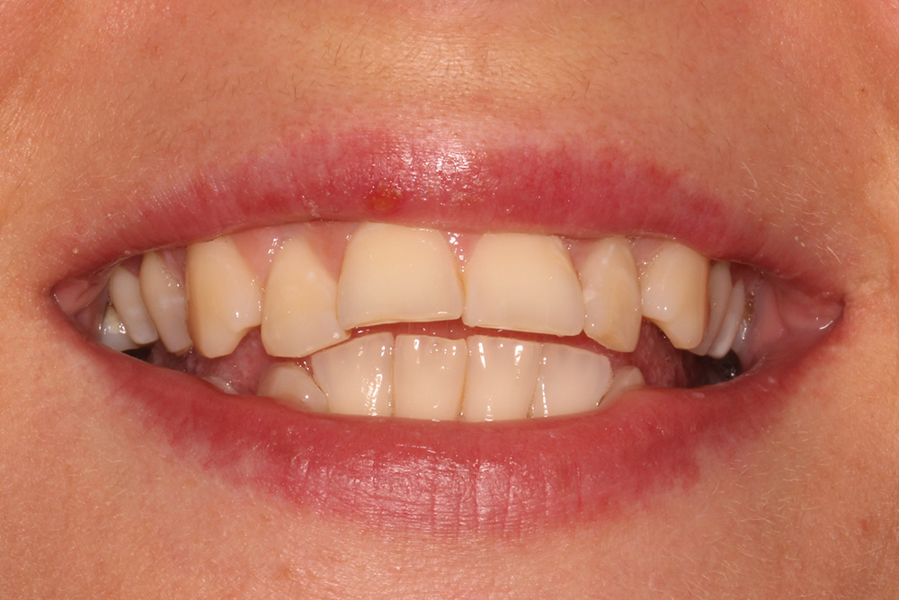 adult braces, tooth whitening and composite bonding