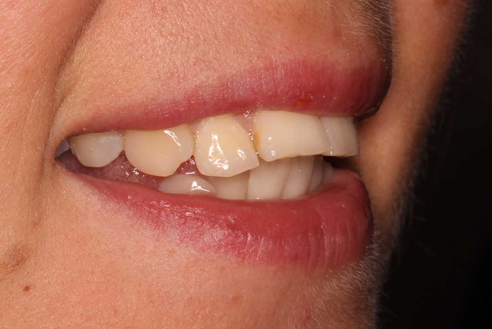 adult braces, tooth whitening and composite bonding